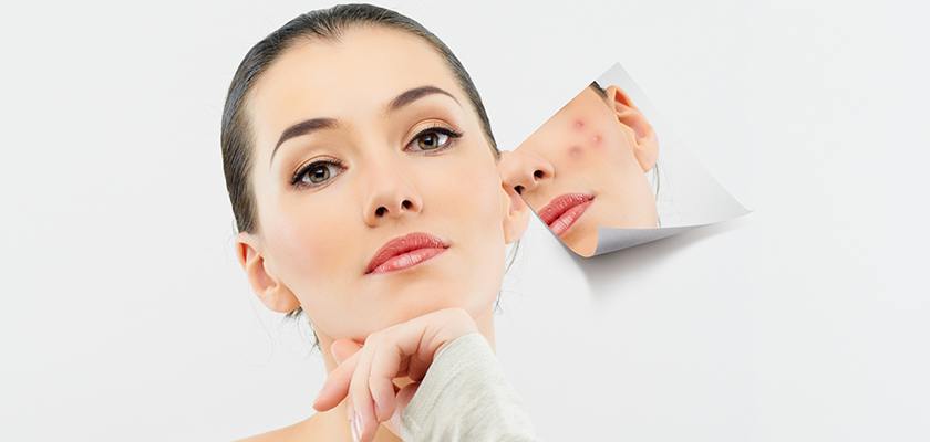 Acne Skin Care
